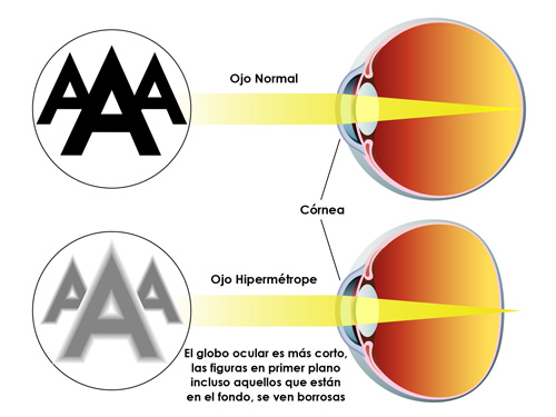 Hipermetropia este plus 5 - Afecțiuni de vedere